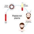 Platelet-rich plasma. PRP Hair Therapy. Medical procedure Royalty Free Stock Photo